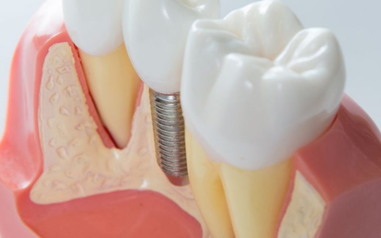 Implanty zębowe, czyli innowacyjne rozwiązanie przywracające piękny uśmiech – Implantis